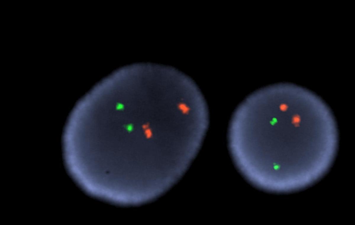 FISH for the PML/RARA fusion associated with the translocation t(15;17)(q22;q21) was negative for the typical fusion as well as abnormal patterns.